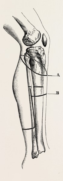 disarticulation isarticulation, medical equipment, surgical instrument, history of medicine