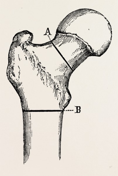 osteotomy, medical equipment, surgical instrument, history of medicine