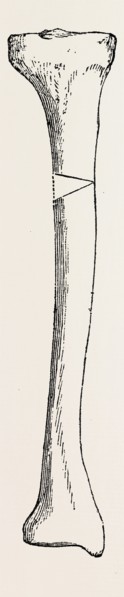 diagram representing a curved tibia, with a wedge removed, medical equipment, surgical instrument,