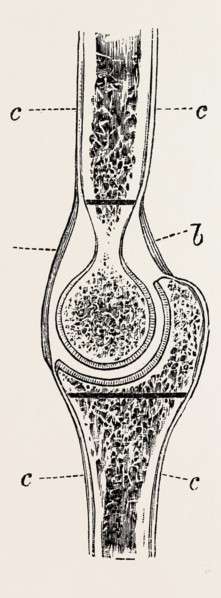 diagrams to illustrate the sub-periosteal method of resection, medical equipment, surgical