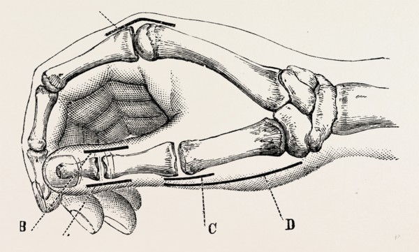 excision of metacarpo-phalangeal joint, medical equipment, surgical instrument, history of medicine