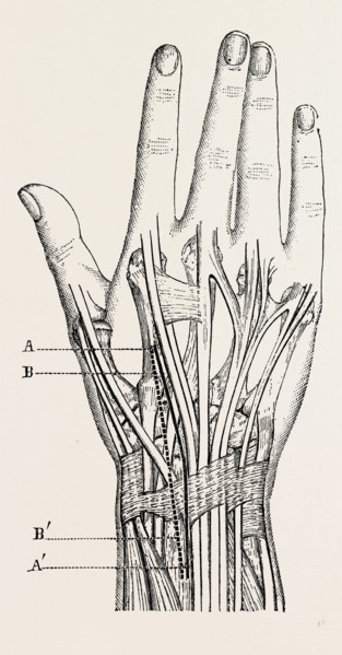 excision of the wrist, medical equipment, surgical instrument, history of medicine