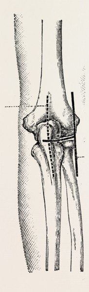 excision, medical equipment, surgical instrument, history of medicine