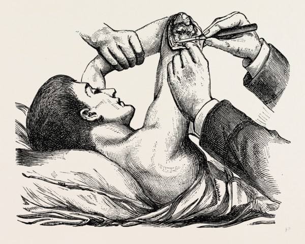 excision of the elbow, the clearing of the humerus, medical equipment, surgical instrument, history