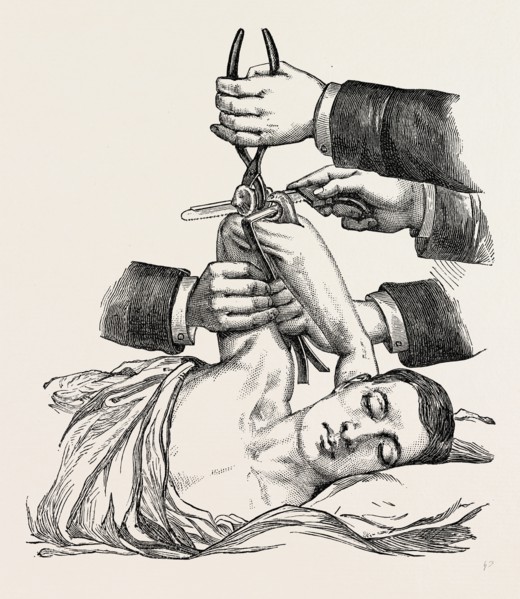 excision of the elbow, sawing of the humerus, medical equipment, surgical instrument, history of