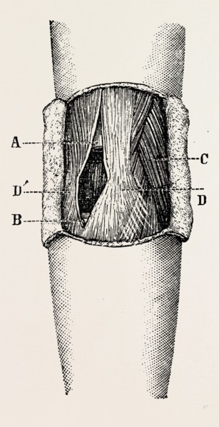 right elbow after excision, medical equipment, surgical instrument, history of medicine