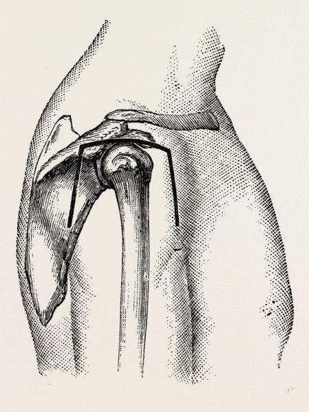 excision, medical equipment, surgical instrument, history of medicine