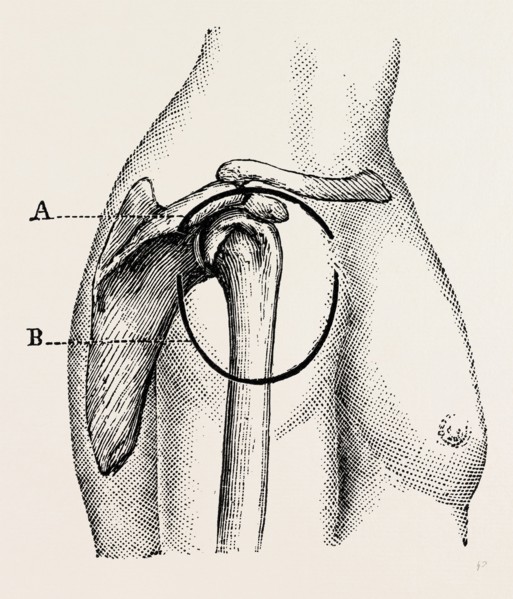 excision of the shoulder, medical equipment, surgical instrument, history of medicine