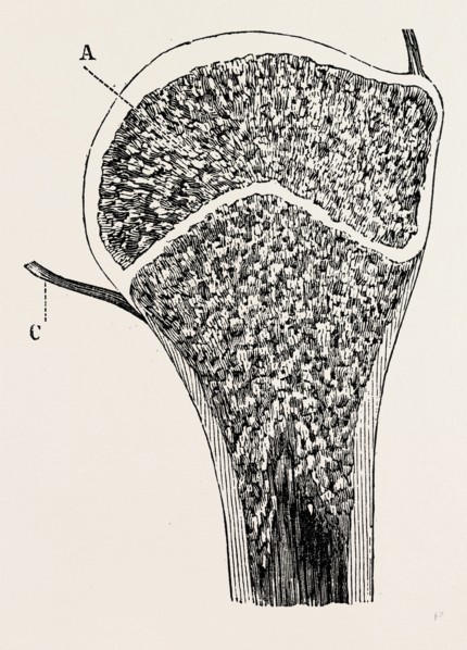 upper end of the humerus, medical equipment, surgical instrument, history of medicine
