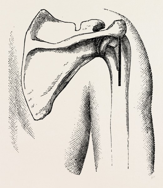 excision of shoulder, medical equipment, surgical instrument, history of medicine