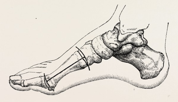 excision of first metatarsal bone, medical equipment, surgical instrument, history of medicine
