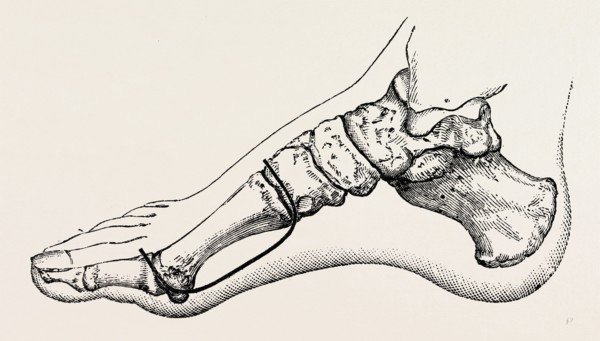 eicision of first metatarsal bone, flap, medical equipment, surgical instrument, history of