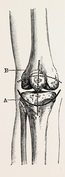 excision of the operation the limb, medical equipment, surgical instrument, history of medicine