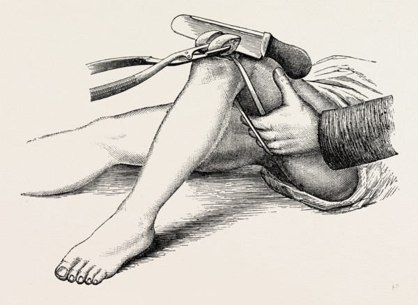 excision of the knee, the sawing of the lower end, medical equipment, surgical instrument, history
