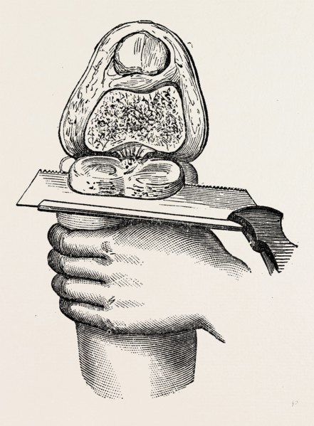 excision of the knee, medical equipment, surgical instrument, history of medicine