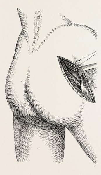 excision of the hip by an external incision, medical equipment, surgical instrument, history of