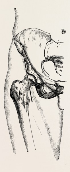 excision, medical equipment, surgical instrument, history of medicine