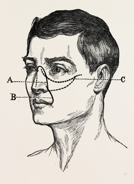 operations for naso-pharyngral, medical equipment, surgical instrument, history of medicine