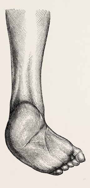 incurved form of the foot, the planzar, medical equipment, surgical instrument, history of medicine