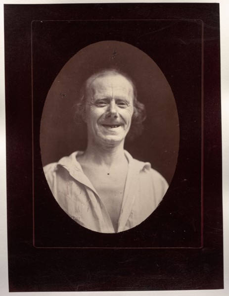 Mécanisme de la physionomie humaine: Figure 32: Rire naturel par la contraction volontaire des deux