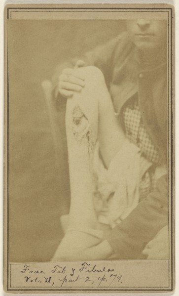 Frank S. Hardy Civil War victim; Attributed to William H. Bell, American, 1830 - 1910, October 30, 1864; Albumen silver print