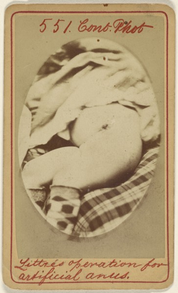 Littre's operation for artificial anus; J.H. Pooley, American, active 1870s - 1880s, December 22, 1871; Albumen silver print
