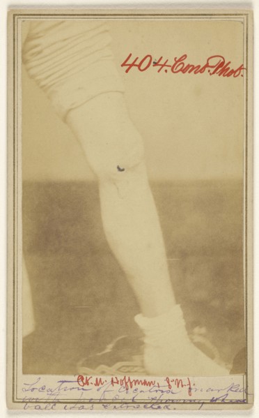 M. Hoffman, Civil War victim; Dr. R.B. Brown, American, active Washington, D.C. 1860s, 1862 - 1864; Albumen silver print