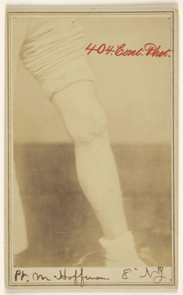 Pt. M. Hoffman, 8' N.J. Civil War victim; Dr. R.B. Brown, American, active Washington, D.C. 1860s, 1862 - 1864; Albumen silver