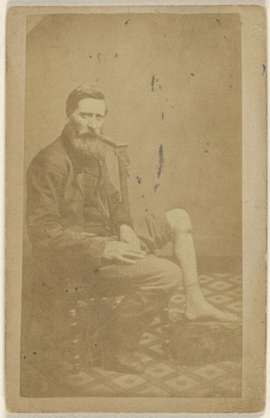 No.5 Case of John Measor U.S.V. Excision of the Tibia; American; 1864 - 1870; Albumen silver print