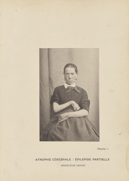 Atrophie Cérébrale: Épilepsie Partielle Hémiplégie Droite; Paul-Marie-Léon Regnard, French, 1850 - 1927, Paris, France; 1878