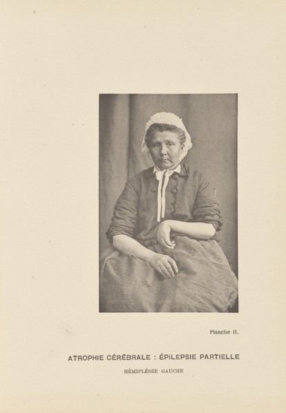 Atrophie Cérébrale: Épilepsie Partielle Hémiplégie Gauche; Paul-Marie-Léon Regnard, French, 1850 - 1927, Paris, France; 1878