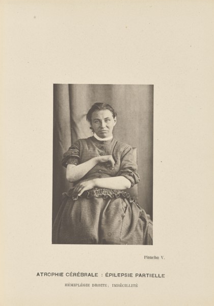 Atrophie Cérébrale: Épilepsie Partielle Hémiplégie Droite; Imbécillité; Paul-Marie-Léon Regnard, French, 1850 - 1927, Paris
