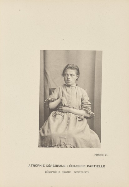 Atrophie Cérébrale: Épilepsie Partielle Hémiplégie Droite; Imbécillité; Paul-Marie-Léon Regnard, French, 1850 - 1927, Paris