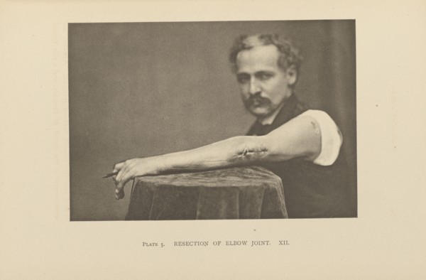 Resection of Elbow Joint; Charles B. Brigham, American, 1845 - 1903, Cambridge, Massachusetts, United States; 1876; Heliotype