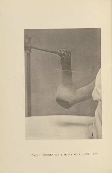 Congenital Fibroma Molluscum; Charles B. Brigham, American, 1845 - 1903, Cambridge, Massachusetts, United States; 1876