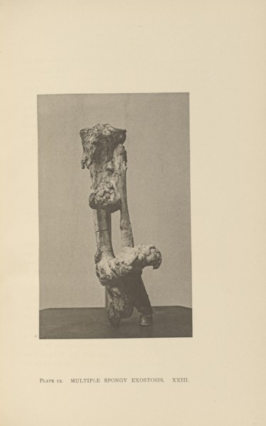 Multiple Spongy Exostosis; Charles B. Brigham, American, 1845 - 1903, Cambridge, Massachusetts, United States; 1876; Heliotype