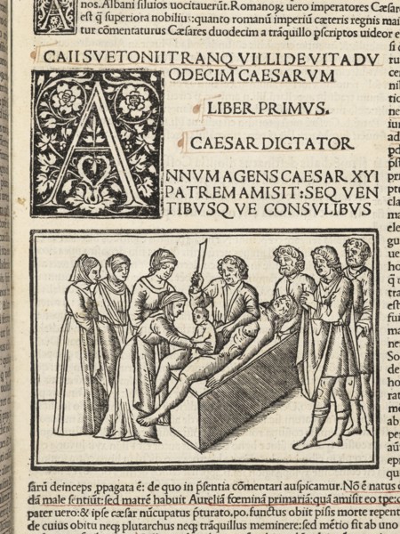 Detail of leaf, 5, recto with illustration depicting Julius Caesar's birth by caesarian section, Suetonius Tranquillus cum