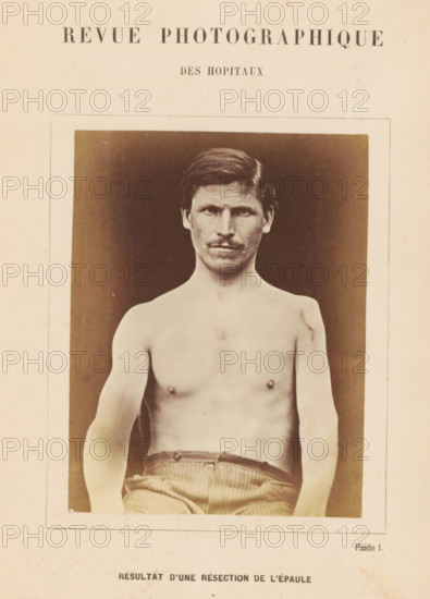 Result d'une résection de l'épaule, Portrait of an unknown man after a shoulder resection,