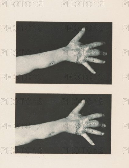 Two views of an arm with symptoms of skin lupus, page, photomechanical print, stereograph,