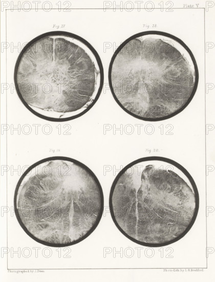 Four details of a human medulla oblongata, page, photomechanical print, number: 'Plate V. Fig. 17.