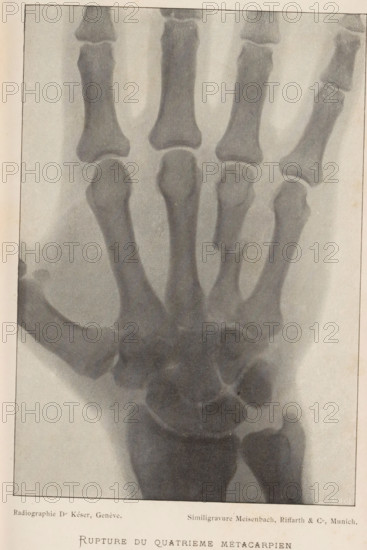 Rupture du Quatrième Métacarpien, X-ray of a hand with a broken metacarpal, page, photomechanical