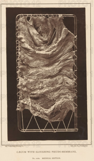 Caecum with Sloughing Pseudo-Membrane, page, photomechanical print, address: '1002 Arch St.,