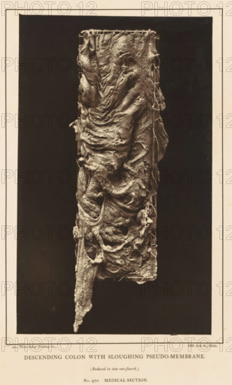 Descending Colon with Sloughing Pseudo-Membrane, page, photomechanical print, address: '1002 Arch