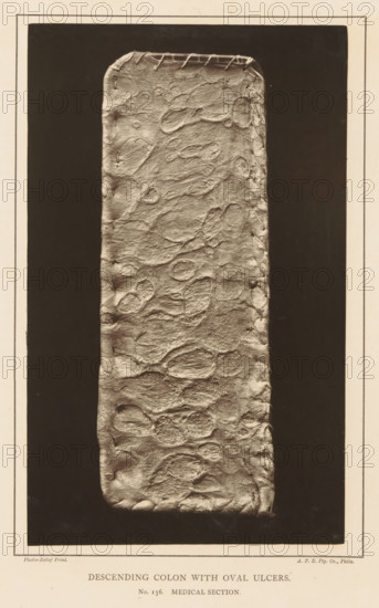 Descending Colon with Oval Ulcers, page, photomechanical print, number: 'No. 136. MEDICAL SECTION