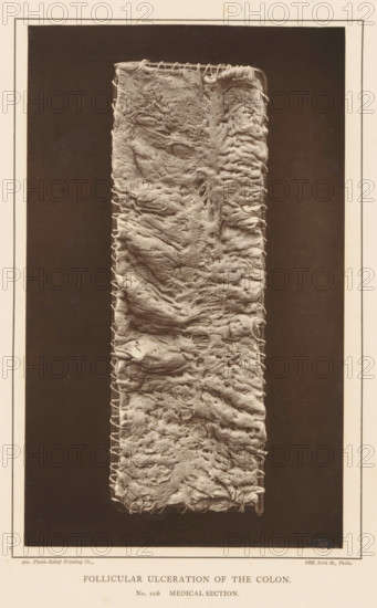 Strained section of colon with swollen cavities, Follicular Ulceration of the Colon, page,