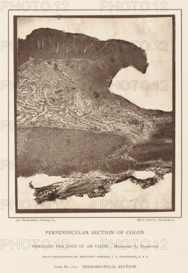 Perpendicular Section of Colon, through the Edge of an Ulcer, Enlargement of the edge of an ulcer
