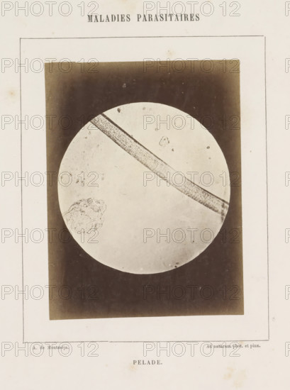 Microscopic image of the disease alopecia areata, Pelade, photograph, page, inscription: 'Ad
