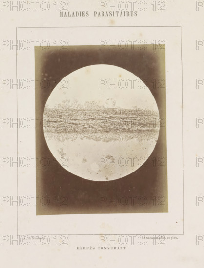 Microscopic image of ringworm on the head, Herpès tonsurant, photograph, page, number: '17',