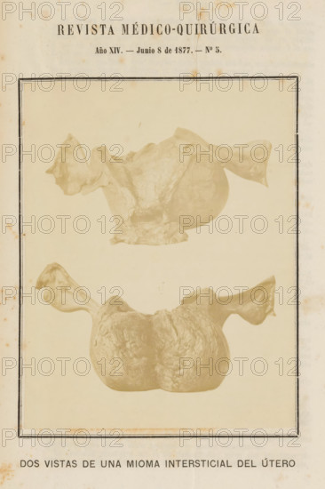 Dos Vistas de Una Mioma Intersticial del Útero, Two views of a uterus with a benign tumor formed by