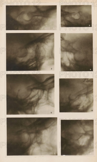 Eight x-rays, photograph, page, name: 'Dr. Alban Köhler', c. 1904 - in or before 1909,